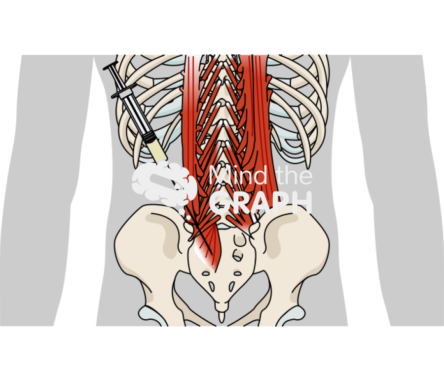 Sacral erector spinae plane block Icons, Symbols, Pictures, and Images